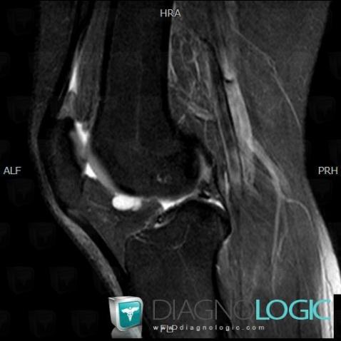 Synovial cyst, Femorotibial joints - Intercondylar notch, Other soft tissues/nerves - Knee, MRI