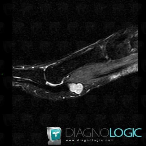 Radiology case : Synovial cyst (MRI) - Diagnologic