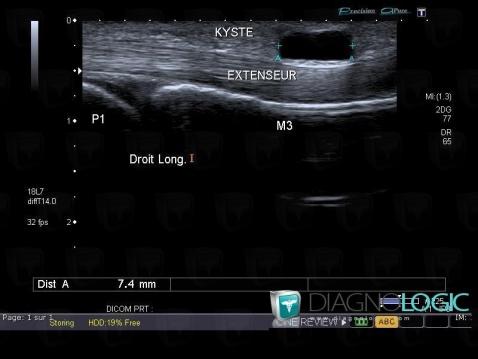 Synovial cyst, Other soft tissues/nerves - Hand, US