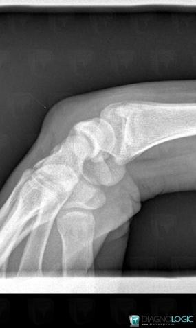 Synovial cyst, Other soft tissues/nerves - Hand, X rays