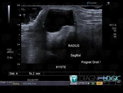 Synovial cyst, Other soft tissues/nerves - Wrist, US