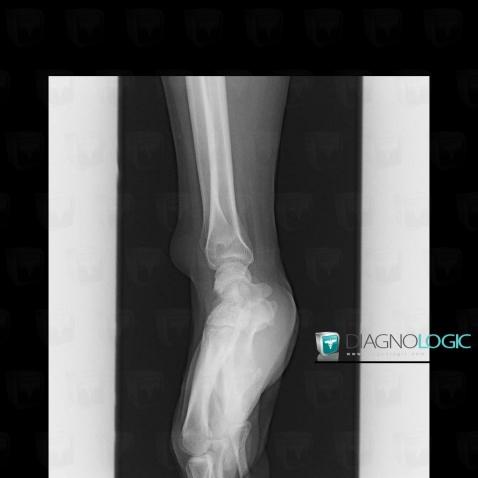 Radiology case : Synovial cyst (US ,X rays) - Diagnologic