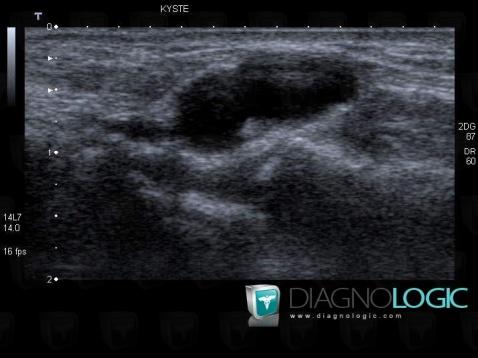 Synovial cyst, Radiocarpal joint, US