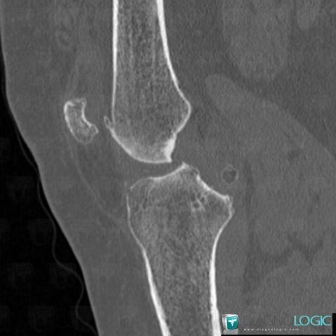 Synovial osteochondromatosis, Femorotibial joints - Intercondylar notch, CT