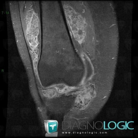 Synovial osteochondromatosis, Femorotibial joints - Intercondylar notch, MRI