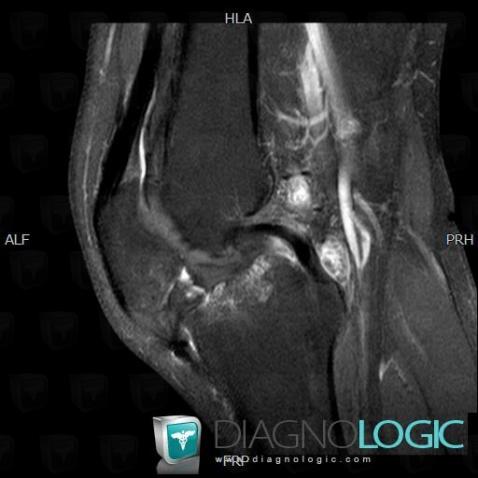 Synovial osteochondromatosis, Femorotibial joints - Intercondylar notch, MRI