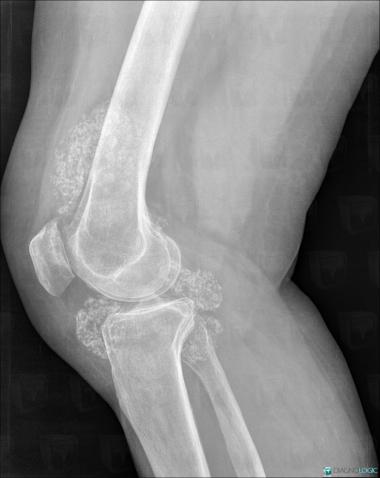 Synovial osteochondromatosis, Femorotibial joints - Intercondylar notch, Other soft tissues/nerves - Knee, X rays