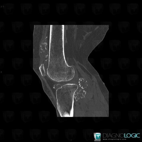 Synovial osteochondromatosis, Femorotibial joints - Intercondylar notch, Patellofemoral joint, CT