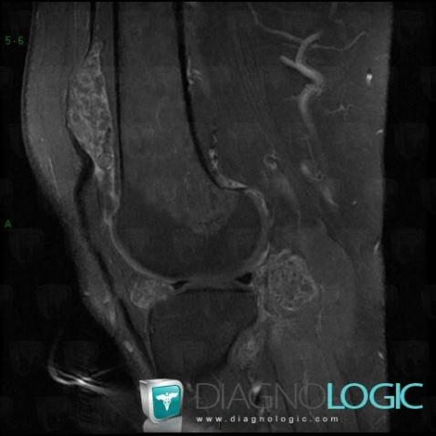 Synovial osteochondromatosis, Femorotibial joints - Intercondylar notch, Patellofemoral joint, MRI