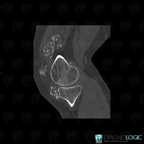 Synovial osteochondromatosis, Femur - Distal part, Tibia - Proximal part, CT