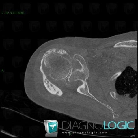 Synovial osteochondromatosis, Gleno humeral joint, CT