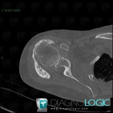 Synovial osteochondromatosis, Gleno humeral joint, CT