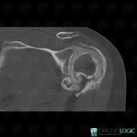 Synovial osteochondromatosis, Gleno humeral joint, CT