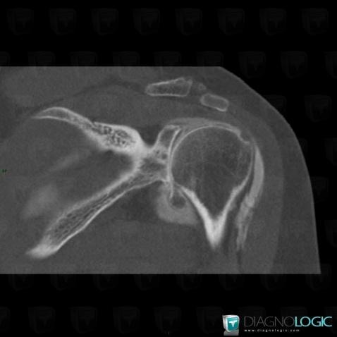 Synovial osteochondromatosis, Gleno humeral joint, CT
