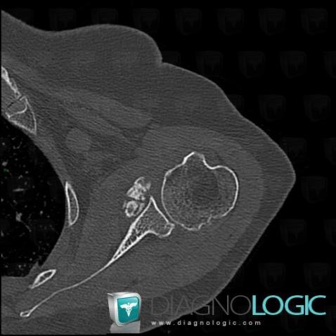 Synovial osteochondromatosis, Gleno humeral joint, Other soft tissues/nerves - Shoulder, CT