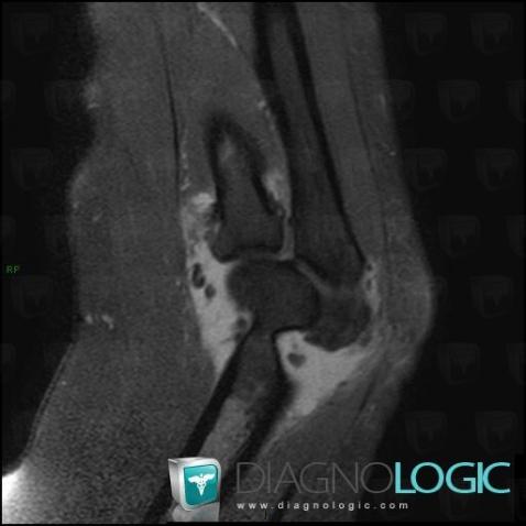 Synovial osteochondromatosis, Joints - Elbow, MRI