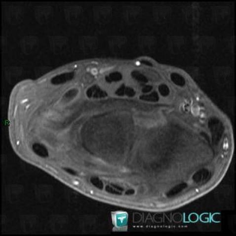 Synovial osteochondromatosis, Mediocarpal joint, MRI