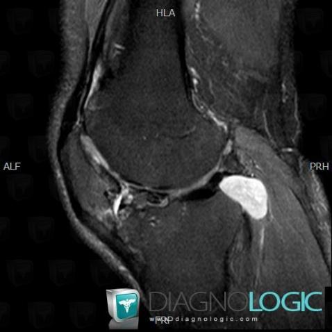 Synovial osteochondromatosis, Other soft tissues/nerves - Knee, MRI