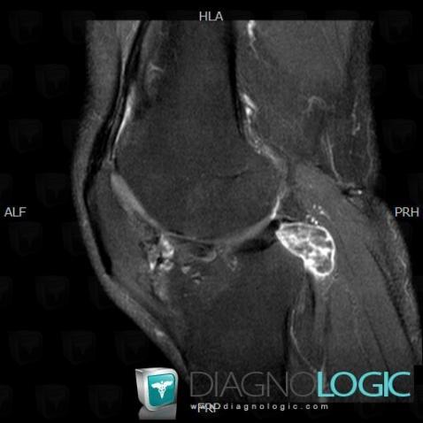 Synovial osteochondromatosis, Other soft tissues/nerves - Knee, MRI