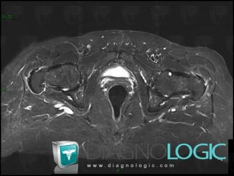 Synovial pit, Femur - Proximal part, MRI