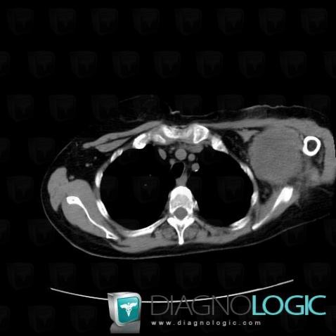 Synovial sarcoma, Chest wall, Other soft tissues/nerves - Shoulder, CT