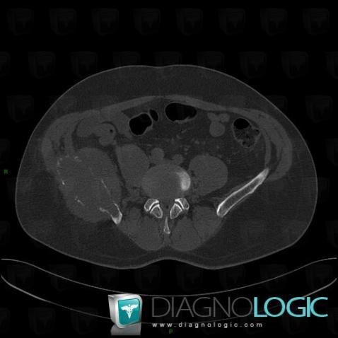 Synovial sarcoma, Ilium, CT