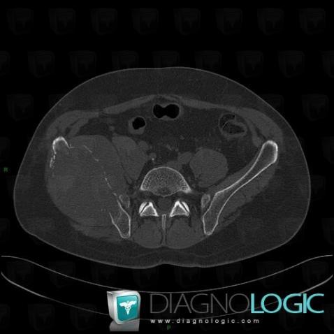 Synovial sarcoma, Ilium, CT