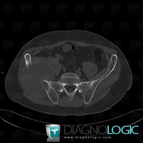 Synovial sarcoma, Ilium, Pelvic Muscles, CT