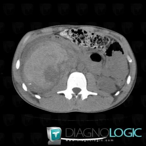 Synovial sarcoma, Kidney, CT