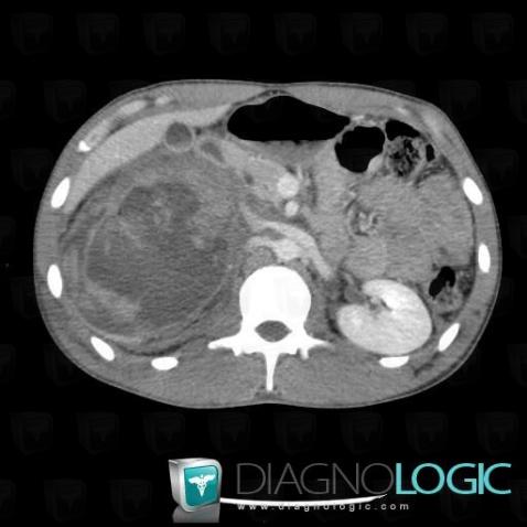 Synovial sarcoma, Kidney, CT