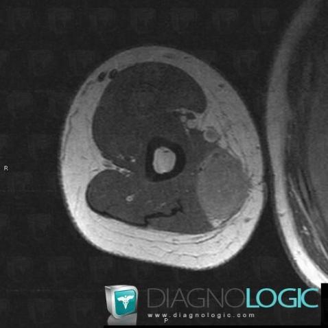 Synovial sarcoma, Muscles - Arm, Other soft tissues/nerves - Arm, MRI
