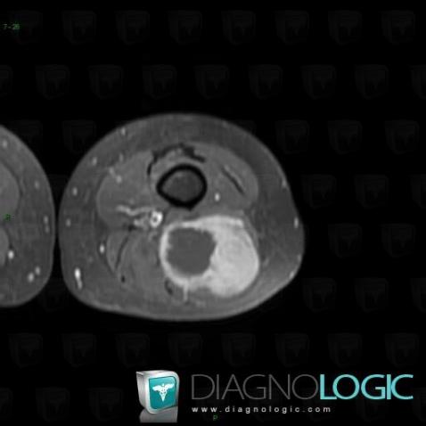 Synovial sarcoma, Muscles - Thigh, Other soft tissues/nerves - Thigh, MRI