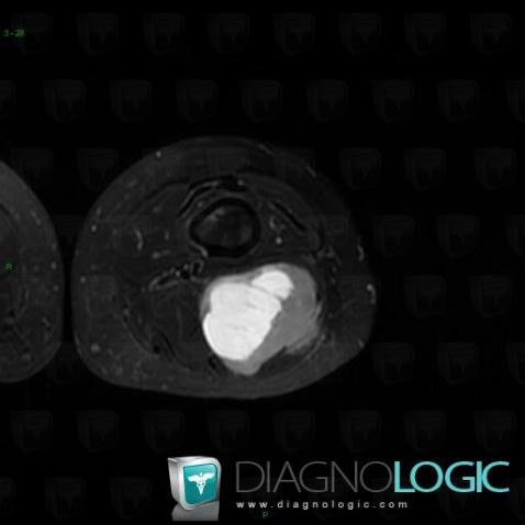 Synovial sarcoma, Muscles - Thigh, Other soft tissues/nerves - Thigh, MRI