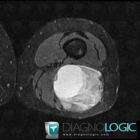 Synovial sarcoma, Muscles - Thigh, Other soft tissues/nerves - Thigh, MRI