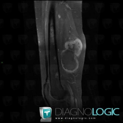 Synovial sarcoma, Muscles - Thigh, Other soft tissues/nerves - Thigh, MRI