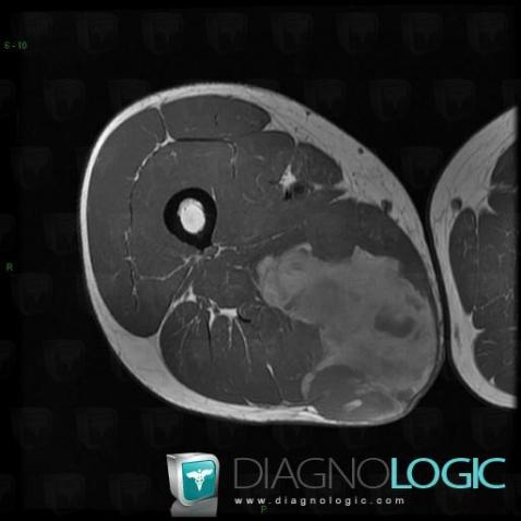 Synovial sarcoma, Muscles - Thigh, Other soft tissues/nerves - Thigh, MRI