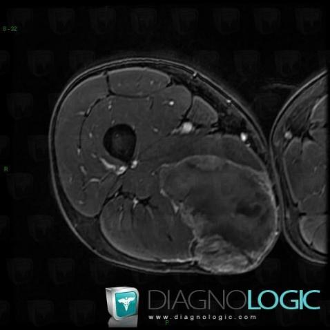 Synovial sarcoma, Muscles - Thigh, Other soft tissues/nerves - Thigh, MRI