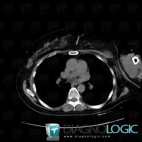 Synovial sarcoma, Other soft tissues/nerves - Arm, CT