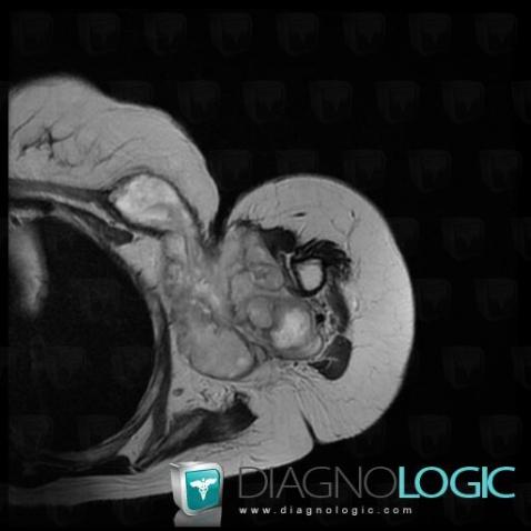 Synovial sarcoma, Other soft tissues/nerves - Arm, MRI