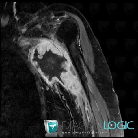 Synovial sarcoma, Other soft tissues/nerves - Arm, MRI