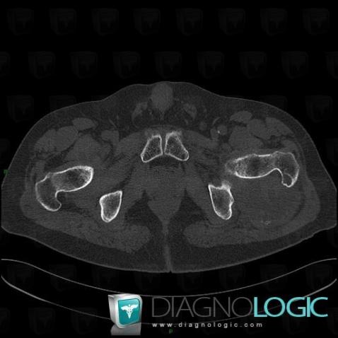 Synovial sarcoma, Pelvic Muscles, Other soft tissues/nerves - Pelvis, CT