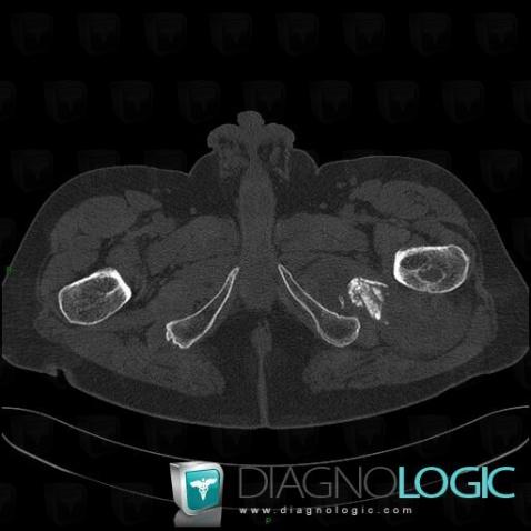 Synovial sarcoma, Pelvic Muscles, Other soft tissues/nerves - Pelvis, CT