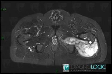 Synovial sarcoma, Pelvic Muscles, Other soft tissues/nerves - Pelvis, MRI