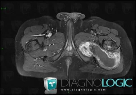 Synovial sarcoma, Pelvic Muscles, Other soft tissues/nerves - Pelvis, MRI