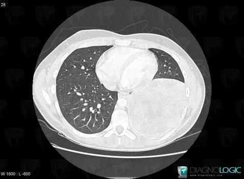 Synovial sarcoma, Pulmonary parenchyma, CT