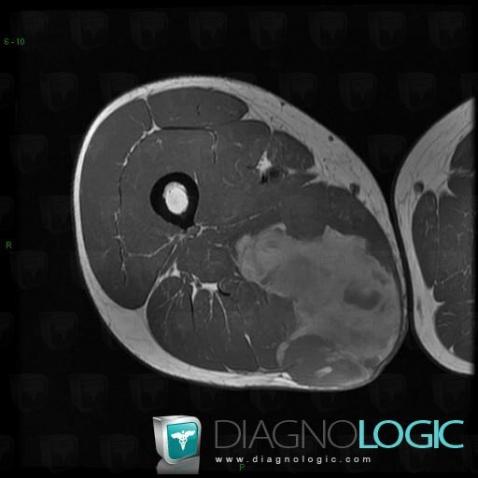 Synovialosarcome, Muscles - Cuisse, Autres parties molles/nerfs - Cuisse, IRM
