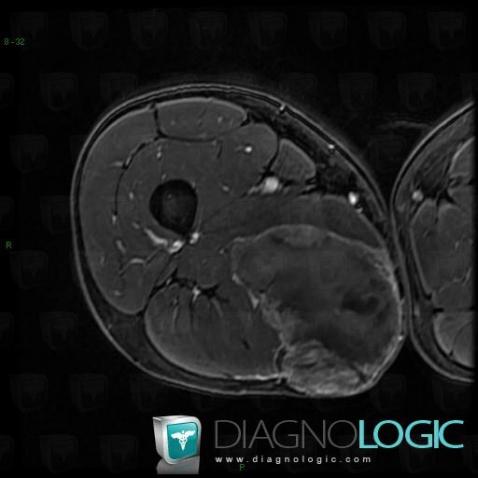 Synovialosarcome, Muscles - Cuisse, Autres parties molles/nerfs - Cuisse, IRM