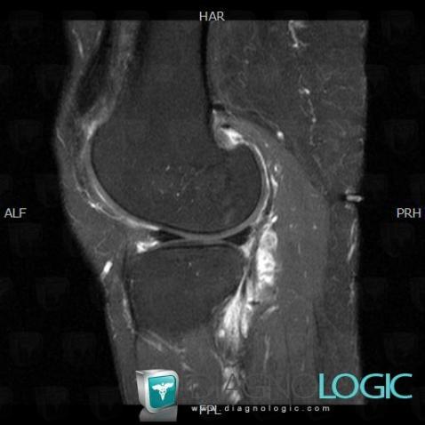 Synovite villonodulaire, Articulations fémoro tibiales / Echancrure, Autres parties molles/nerfs - Genou, IRM