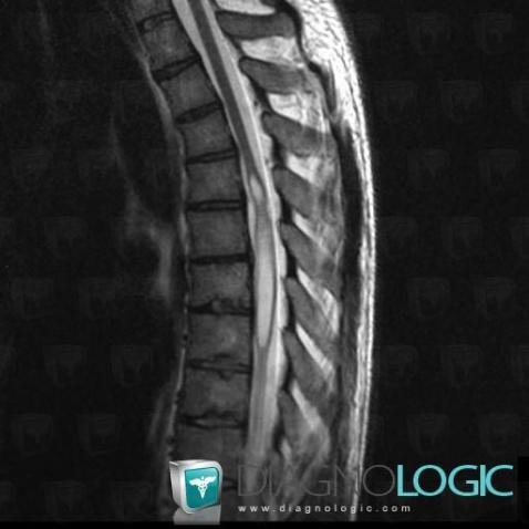 Syringomyelia, Spinal canal / Cord, MRI