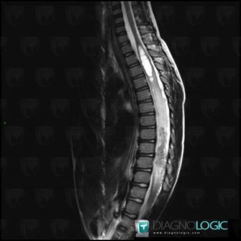 Syringomyelia, Spinal canal / Cord, MRI